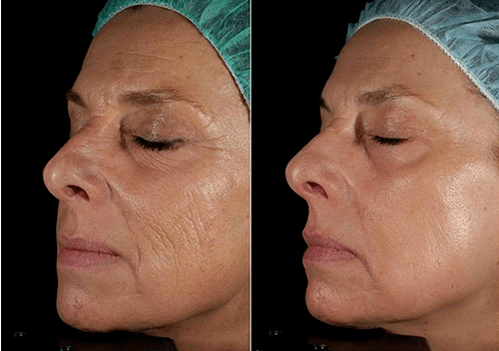 Laser Rejuvenatioun virum no