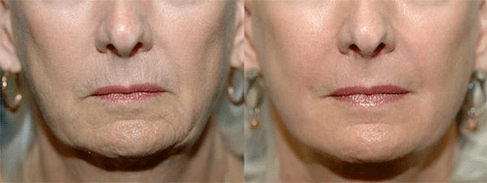 Laser Therapie virun an no