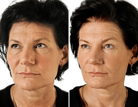 D'Resultat vun der Fraktiounsverbriechung vum Gesiicht