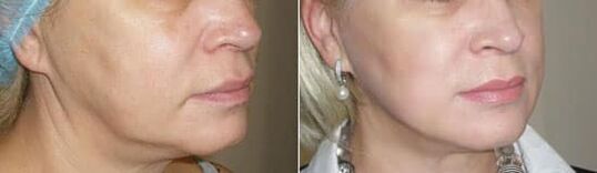 Foto nodeems Dir d'Prozedur applizéiert